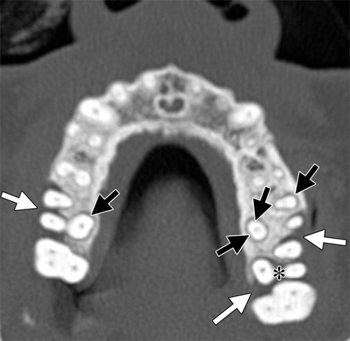 Doença periodontal no raio x