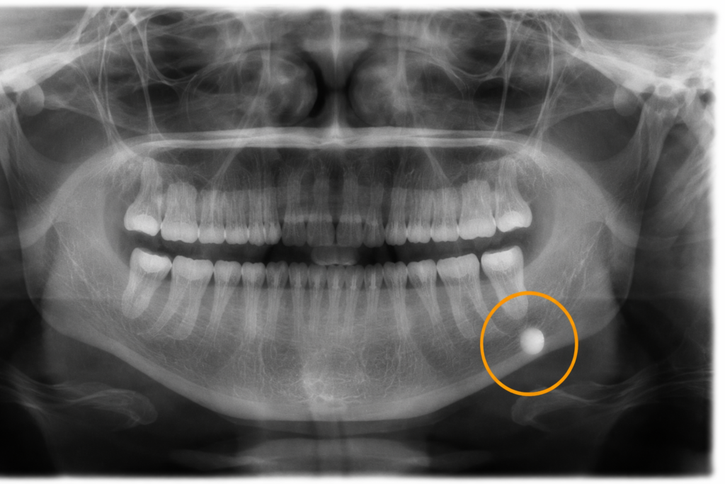calculos nas glandulas salivares